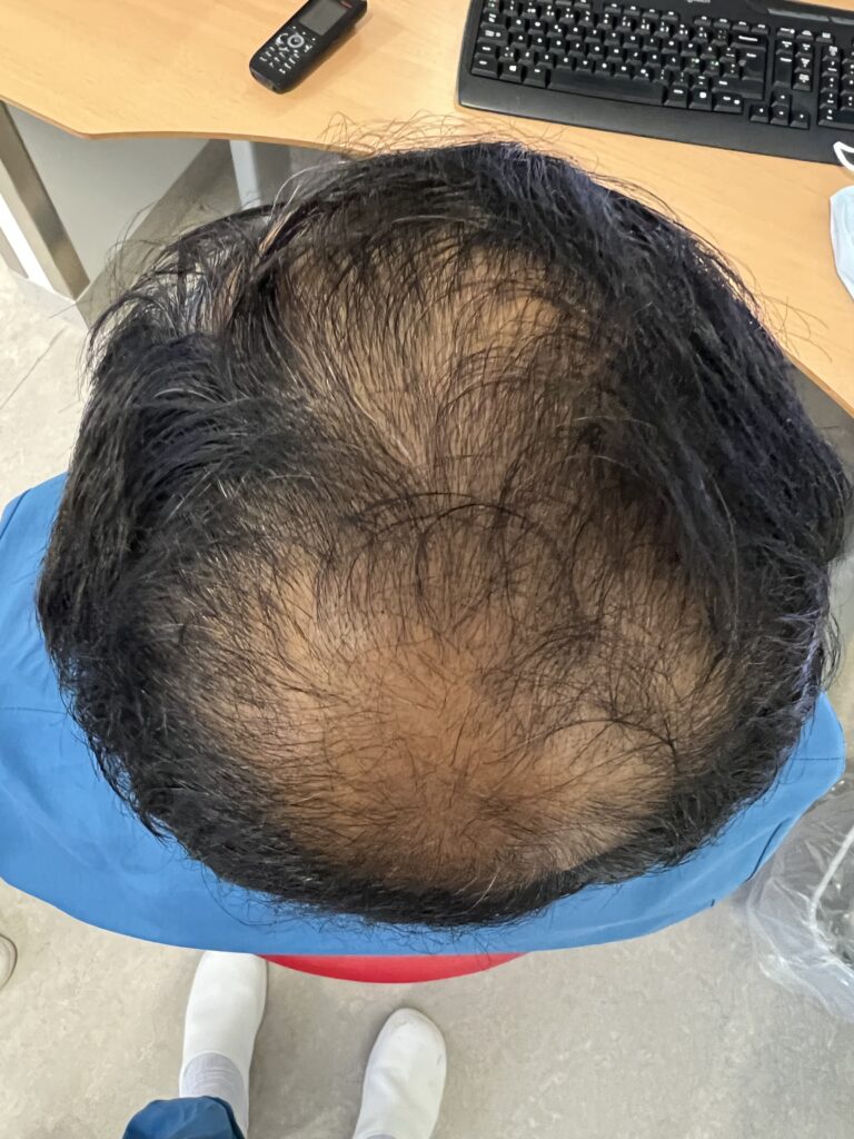 after hair filler - picture of scalp