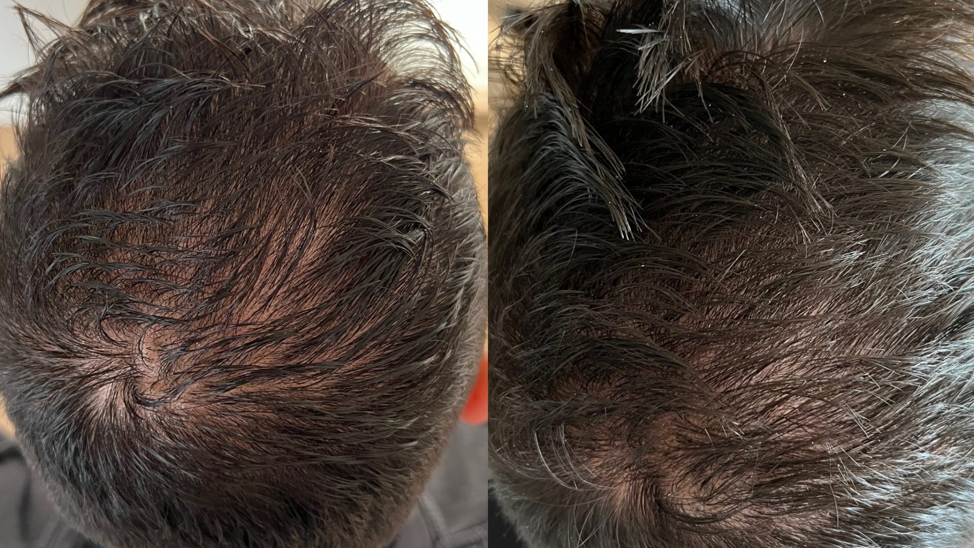 before and after hair filler - picture of scalp