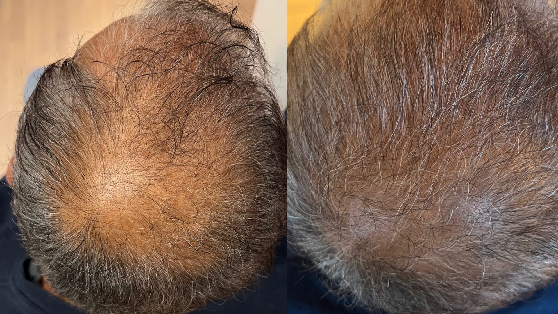 before and after hair filler - picture of scalp